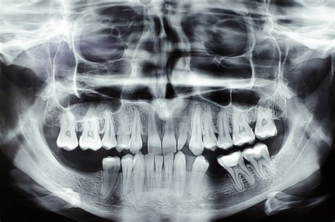 * supports also front facing camera if available (great for taking photos of yourself) * nice xray style sound effect when moving camera * toggle flash to cause nice effects (see the video. Reading Dental X-Rays: What to Look for in Your Treatment - Biltmore Commons Dental Care