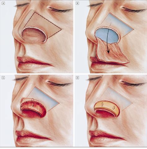 Figure 3 From Reconstruction Of Nasal Alar Defects Semantic Scholar