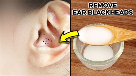 3 Best Ways For Ear Acne Blackheads Removal How To Remove Ear