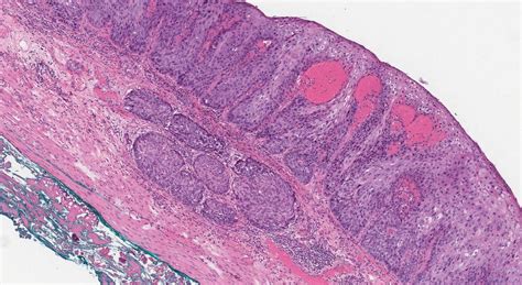 Squamous Cell Carcinoma Of The Esophagus Atlas Of Pathology