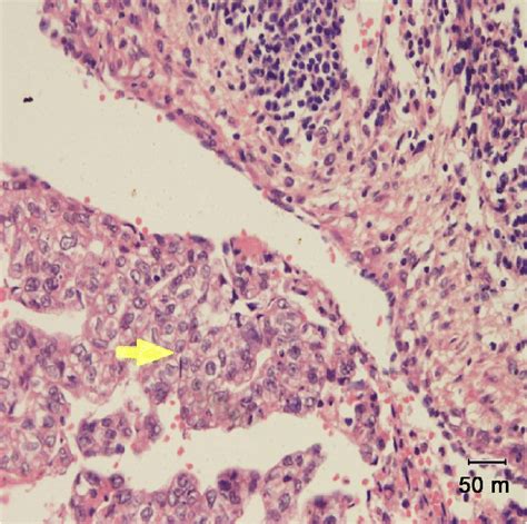 Lymph Node Metastasis Histopathology Section H And E Stain 400×