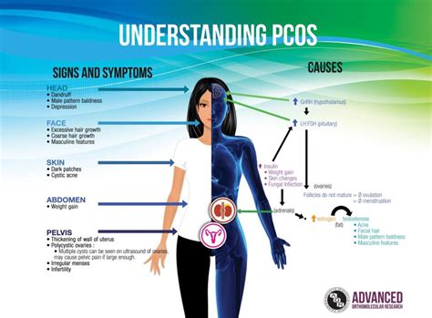 Diet and lifestyle tips for pcos. 5-10% van de vrouwen heeft het: PCOS - I Love Health