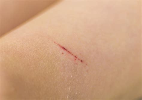 Symptoms And Treatments For Cat Scratch Disease Facty Health