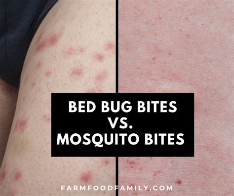 Bed Bug Bites Vs Mosquito Bites Similarities And Differences Photos