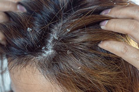 Hardened Sebum On Scalp Hair Loss Topic