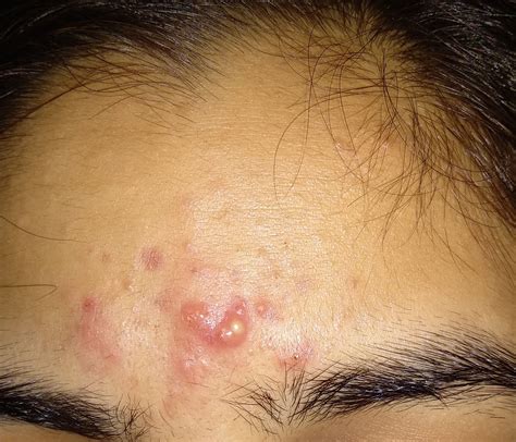 Inflammatory Acne On Forehead General Acne Discussion Forum