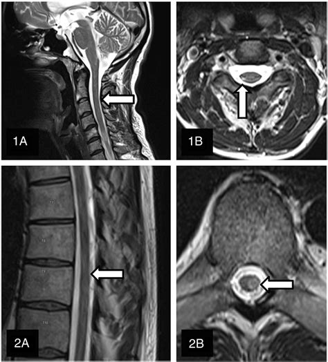 Improved Lesion Detection By Using Axial T Weighted Mri With Full