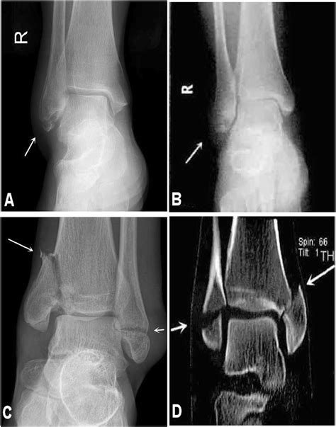 Lateral And Medial Malleolus Fractures Ab The Lateral Malleolus