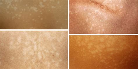 Skin Health White Spots After Tanning Seek Advice From Your Doctor
