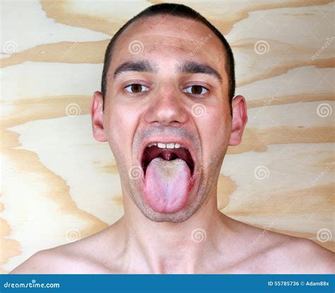 Infection Tongue Candida Albicans Stock Photo Image Of Depression