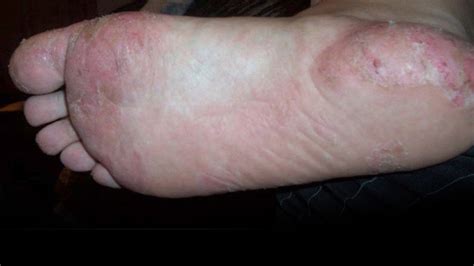 Dyshidrosis Pictures Causes Prevention And Cure Healthdiseasesorg