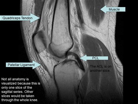 Magnetic Resonance Imaging Knee Injury And Prevention