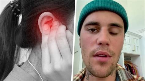 Justin Bieber Parálisis Facial Y Pérdida De La Audición Los Síntomas Del Síndrome De Ramsay