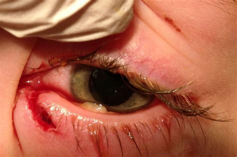 Canalicular Laceration (Trauma) - EyeWiki