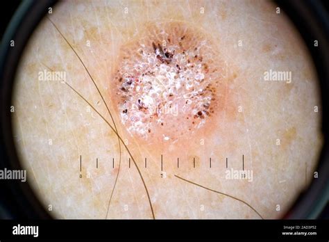 Seborrhoische Keratose Dermatoskop Bild Eines Seborrhoische Keratose