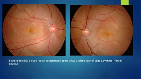 Sympathetic Ophthalmia And Vkh Syndrome