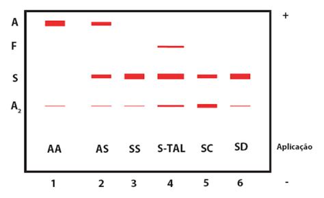 A Anemia Falciforme Análises Clí