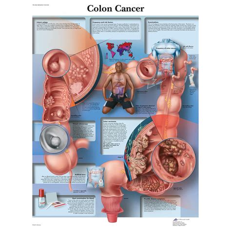 Most colon polyps are harmless. 3B Scientific Colon Cancer Chart