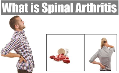 What Is Spinal Arthritis Natural Home Remedies And Supplements