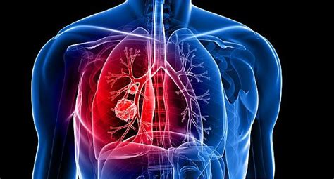 Surprising Signs You Might Have Lung Cancer Thaimedic