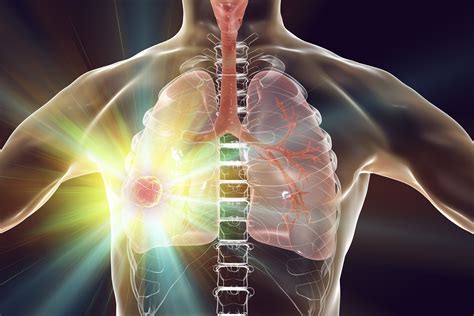 Immunotherapy Drug Shows Potential To Cure Advanced Lung Cancer Yale