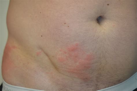 Shingles Treatment Wellesley And Boston Ma Krauss Dermatology