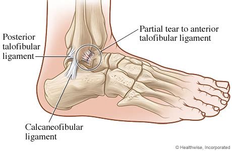 An example is the fibular collateral ligament another condition that can affect ligaments is enthesitis, which is the inflammatory process within the entheses (the places where the tendons and. Ankle With Ligament Tear | HealthLink BC