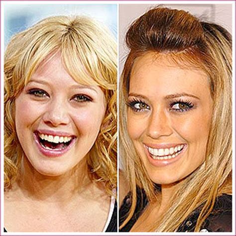 Celebrity Plastic Surgery Before And After 56 Pics Picture 8