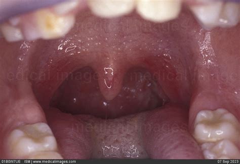 Stock Image Close Up Of Normal Tonsils 90494 01b0w7ue Ism Search