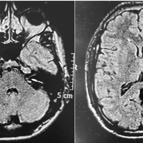 Brain Mri Axial Flair Effect Normal Download Scientific Diagram