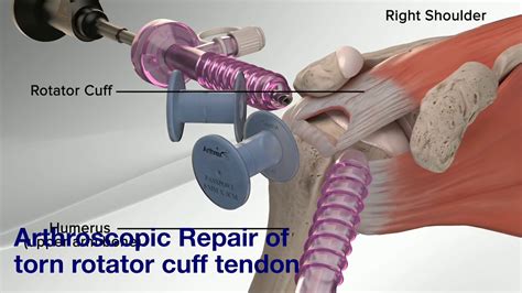 Arthroscopic Rotator Cuff Repair Animation YouTube