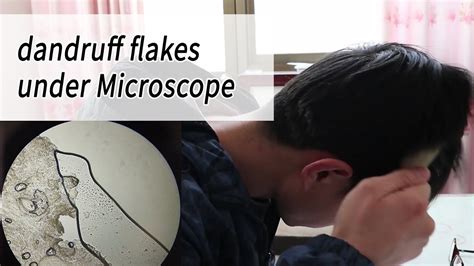 How Dandruff Flakes Look Under Microscope Any Fungi Youtube