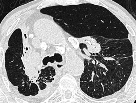 Progressive Massive Fibrosis Due To Silicosis Ct Shows Bilateral