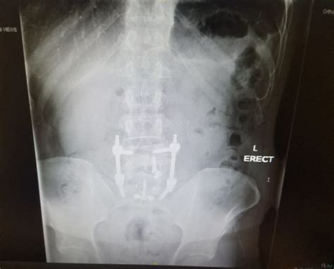 My X Ray After Spinal Fusion Surgery