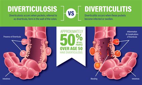 Solved Explain The Difference Between Diverticulosis And