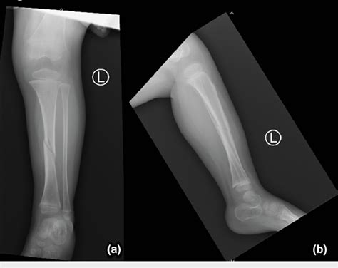 Oblique Spiral Midshaft Diaphyseal Fracture Of The Left Tibia With A