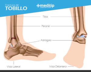 Dolor De Tobillo Causas Enfermedades Y Tratamiento Meditip