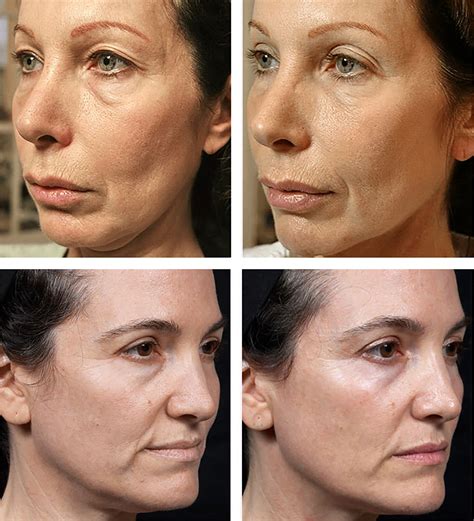 Thermage Treatment Radiofrequency Facelift Dr Sin Yong