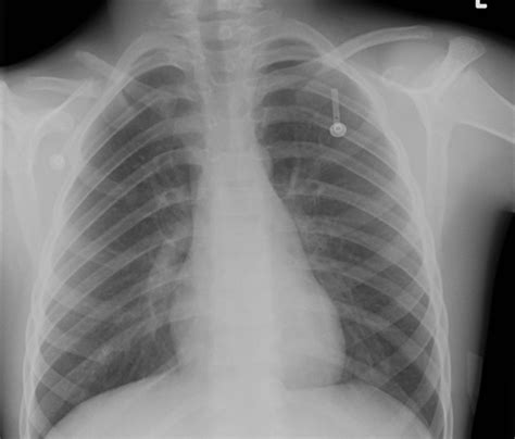 Pseudarthrosis Of Clavicle The Bone School