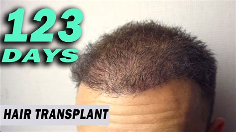 Within the first few weeks after hair transplantation, hair follicles enter the telogen phase, also known as the resting phase. FUE Hair Transplant Day 123 (post op) Istanbul, Turkey ...