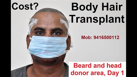 Cost Of Body Hair Transplant Beard Donor And Back Of Head Dr