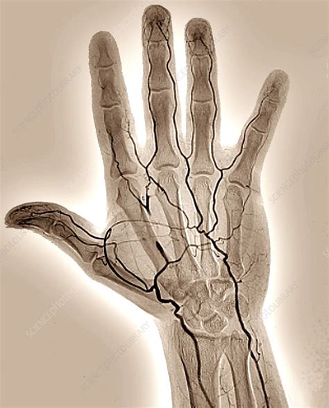 Blocked Hand Artery Angiogram Stock Image C0488753 Science