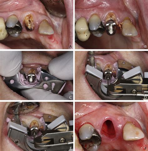 Atraumatic Surgical Extrusion To Improve Tooth Restorability Journal