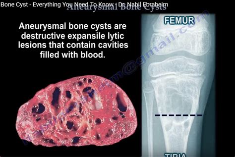 Aneurysmal Bone Cyst —
