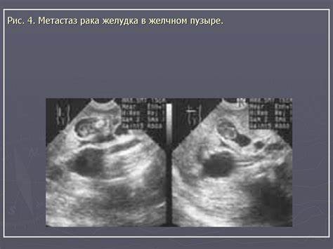 Диета для рака желудка