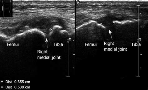 Knee Joint Ultrasound