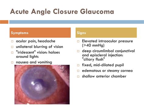 This disease has a familial tendency and is associated with increasing age and hyperopia. Acute Angle Closure Glaucoma Signs And Symptoms ...