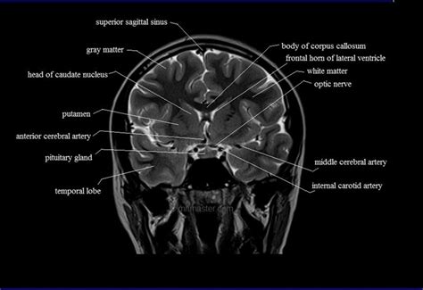 Mri Brain Coronal Cross Sectional Anatomy Image Brain Anatomy Mri