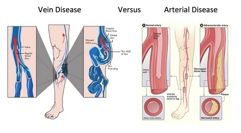 Venous ulcers are usually accompanied by other clinical signs of venous disease such as swelling, pigmentation, varicose dermatitis, atrophie blanche and lipodermatosclerosis. Differences in Vein and Arterial Diseases