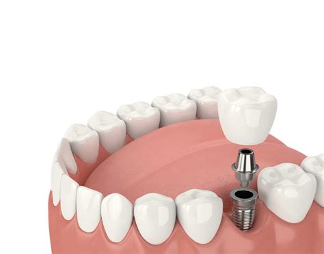 Dental Implant Rightpng 1200×943